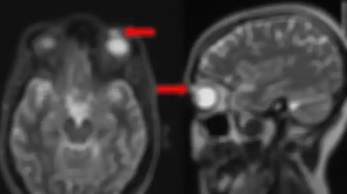 tes MRI yang menunjukkan enkapsulasi lensa kontak