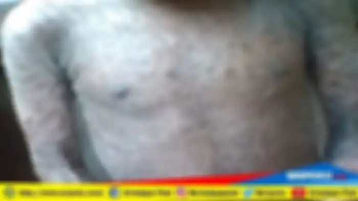 Penampakan kulit berisisk bocah 5 tahun diduga karena sang ayah membunuh ular ketika istri hamil