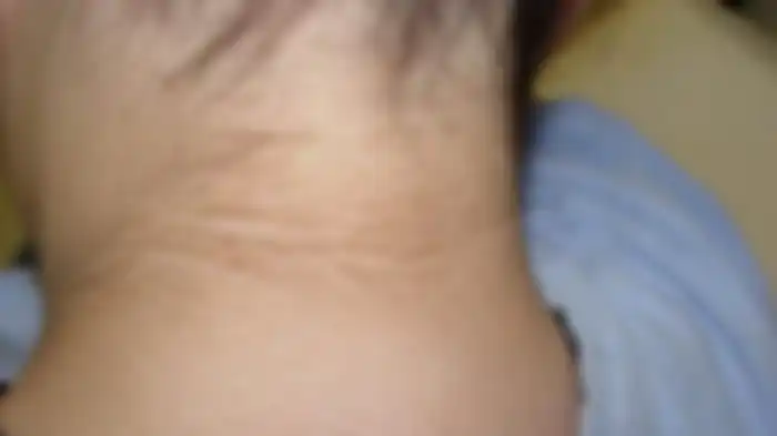 Jangan Dianggap Sepele, Kulit Leher Hitam dan Menebal Ternyata Bisa Menandakan Penyakit Berbahaya ini!