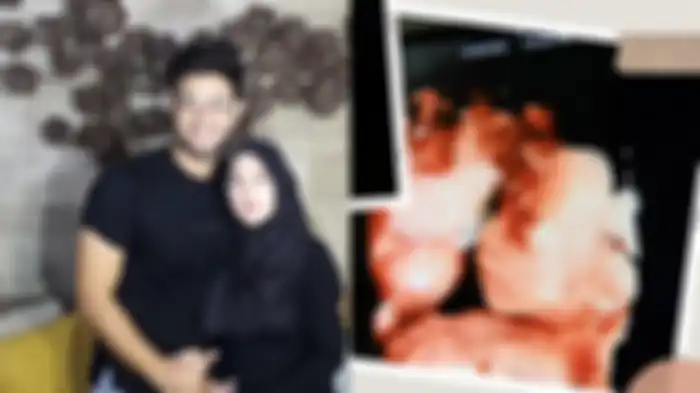 Kolase Ammar Zoni-Irish Bella (kiri) dengan foto USG bayi kembar mereka yang meninggal dunia