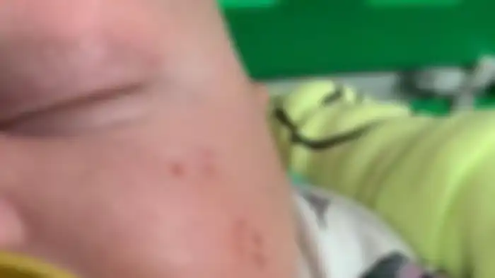 Bayi 8 minggu yang mendapatkan gigitan ular di wajahnya