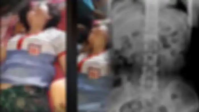 Siswi SMK lumpuh karena cedera tulang ekor