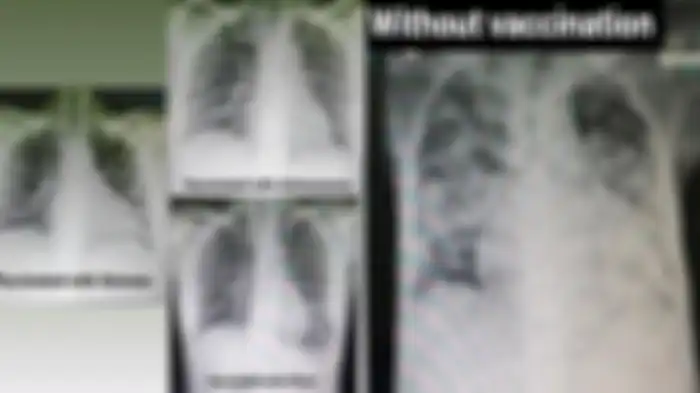 Foto unggahan seorang dokter bernama Dr. Anne Gabriel-Chan menunjukkan hasil rontgen paru-paru orang yang terinfeksi covid-19, yang vaksin dan yang tidak vaksin. 