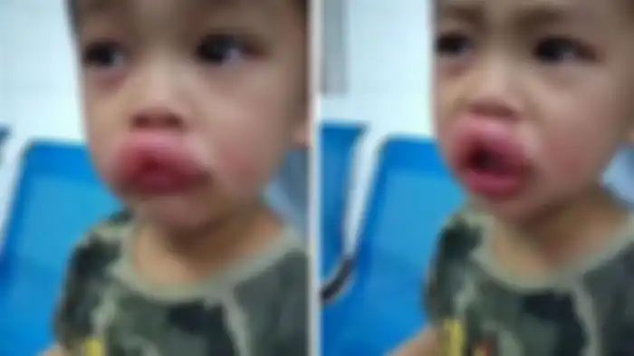 Bibir anak bengkak parah karena makan anggur