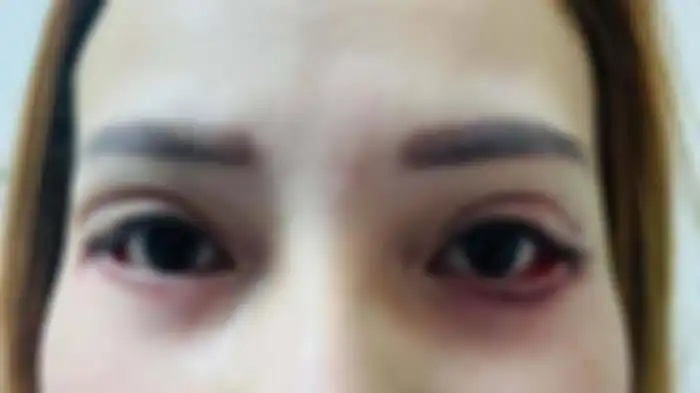 Meski tak pulih 100 persen, wanita ini bersyukur kelopak matanya sudah menutup lagi.