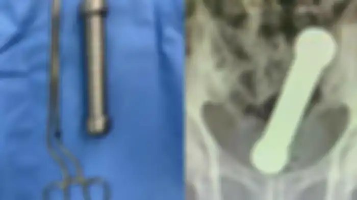 Viral pria di Brasil tancapkan barbel 2 kg ke anus, dokter sampai harus lakukan ini secara manual