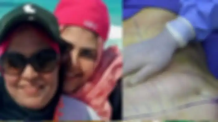 Gadis 19 tahun ini nekat jalani operasi sedot lemak agar tubuh semlehoy