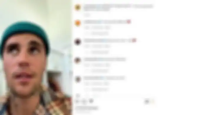 Kondisi wajah Justin Bieber usai alami virus langka
