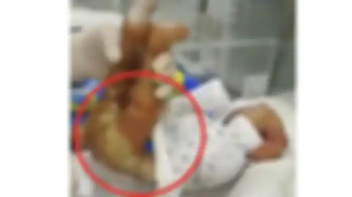 Bayi itu lahir dengan ichthyosis bawaan yang parah  