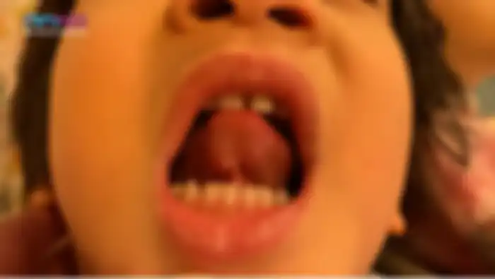 Benjolan di lidah Rafathar