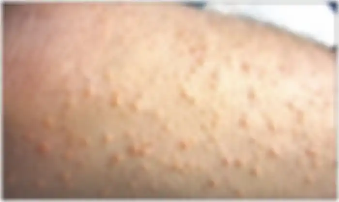 Xanthoma