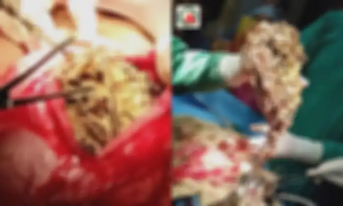 Dokter menemukan berbagai perhiasan senilai lebih dari Rp924 juta di perut seorang wanita
