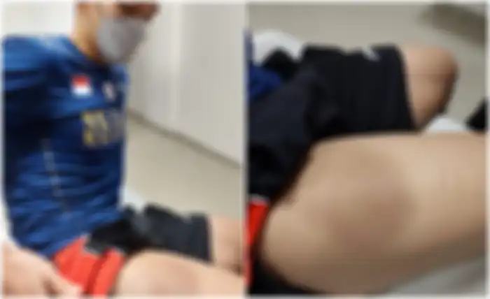 Kaki Jonathan Christie lebam
