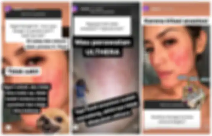 Postingan terbaru Jedar soal kondisi wajahnya