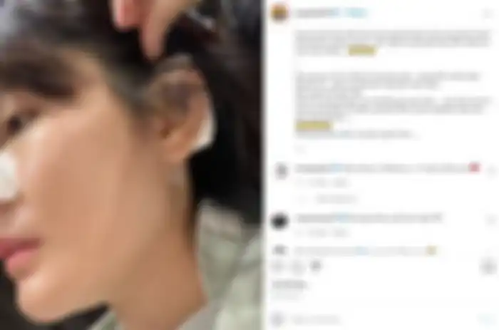 Angela Lee kapok operasi plastik