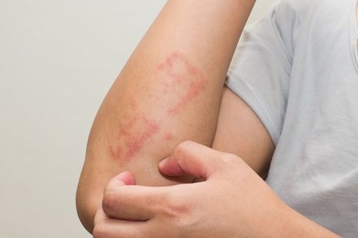 Kenali yuk macam macam psoriasis