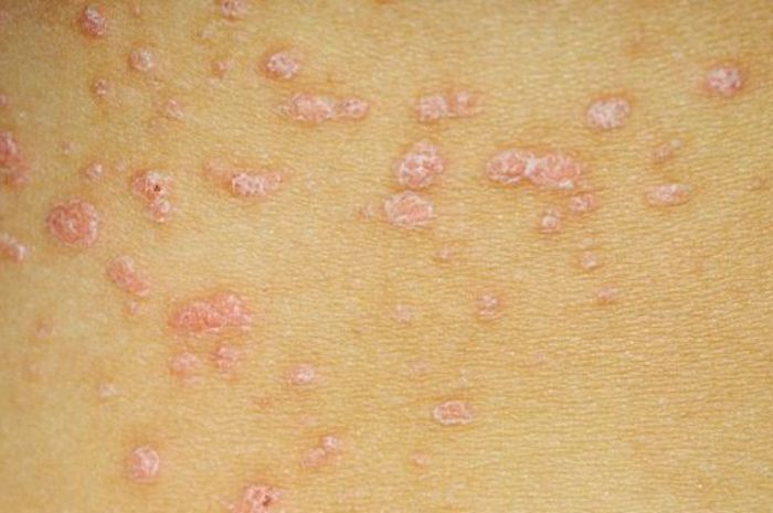 Mengenal psoriasis, peradangan kulit yang bisa semakin parah karena cuaca dan kondisi mental.