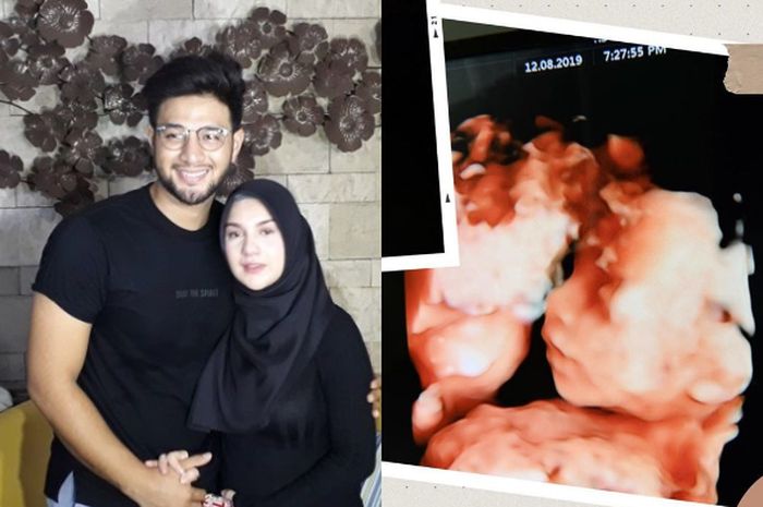 Kolase Ammar Zoni-Irish Bella (kiri) dengan foto USG bayi kembar mereka yang meninggal dunia