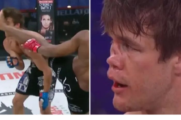 Hidung dan wajah Derek Anderson usai menerima tendangan brutal Michael Page di Bellator 258.