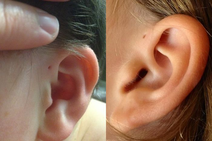 ilustrasi lubang kecil pada telinga