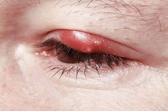 5 Arti Mimpi Mata Bintitan Jangan Dianggap Remeh, Simbol Stres dan Kelelahan