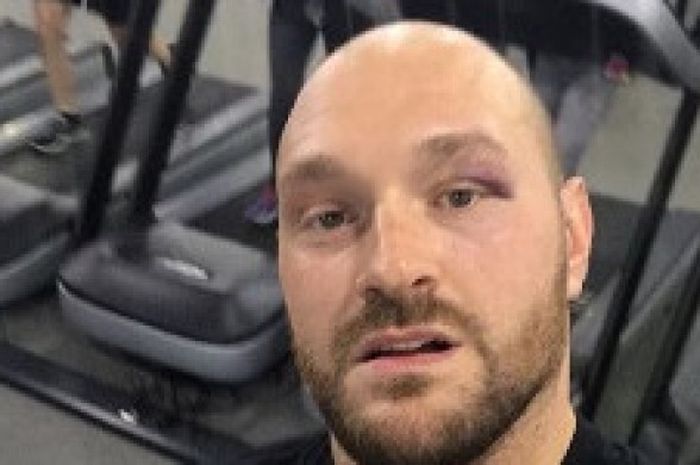 Petinju kelas berat Inggris, Tyson Fury, pamerkan lebam di mata setelah sparing dengan rekannya.