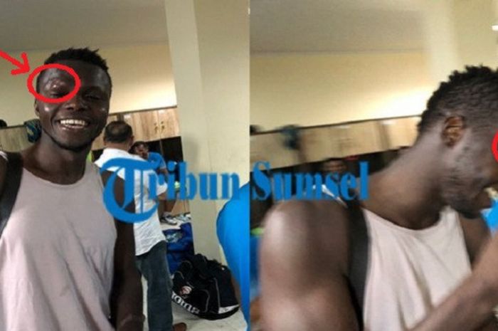 NDiaye mendapat hadiah benjolan besar saat uji coba bersama Sriwijaya FC.