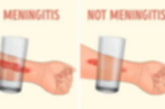 Buktikan Gejala Meningitis dengan Gelas Kaca, Gimana Caranya?