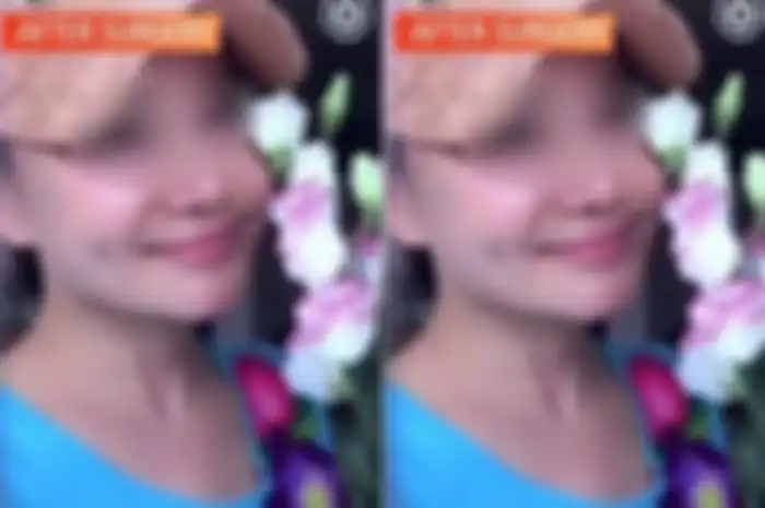 Wanita menjalani operasi plastik dan hidup mewah.