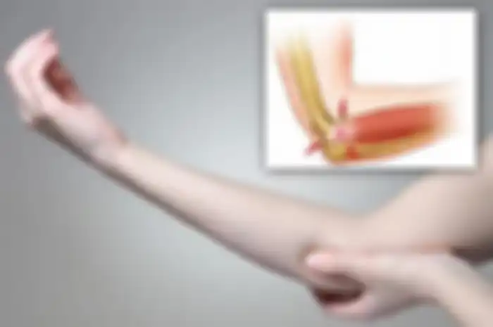 Tennis elbow terdiri dari pembengkakan di tendon antara otot lengan bawah dan bagian luar siku yang menyebabkan rasa sakit dan nyeri di siku.