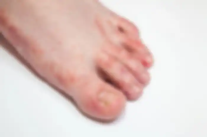 Kaki atlet adalah penyakit yang disebabkan oleh jamur, yang biasanya muncul di jari-jari kaki, tumit, bahkan telapak tangan.