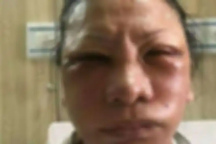 Ratna Sarumpaet bengkak pascaoperasi sedot lemak pada wajah.