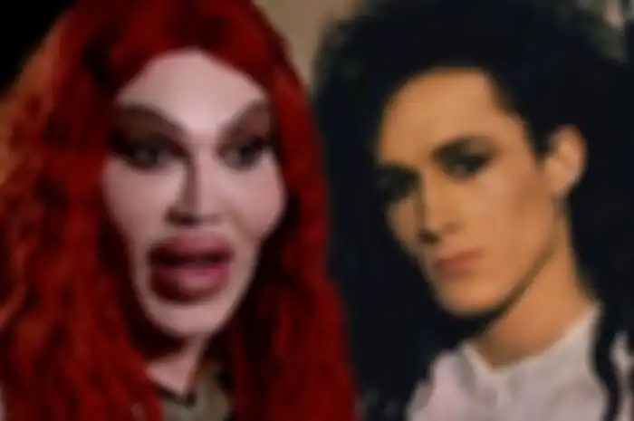 Pete Burns jalani salah satu operasi plastik paling gagal di dunia