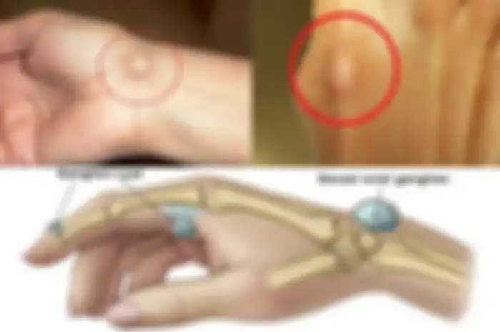 Ganglion cysts adalah jenis massa yang menonjol dan timbul di tangan serta dapat tumbuh di bagian atas, samping, atau bawah pergelangan tangan. 