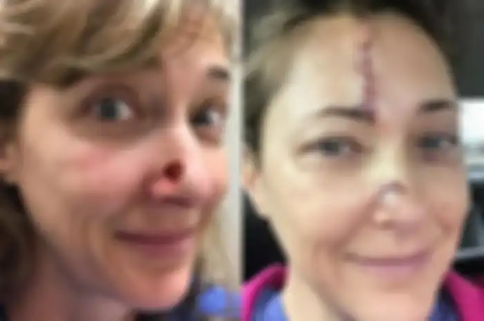 Malas Pakai Sunblock dari Remaja, Wanita 42 Tahun  ini Justru Alami Kanker Kulit yang Mengerikan