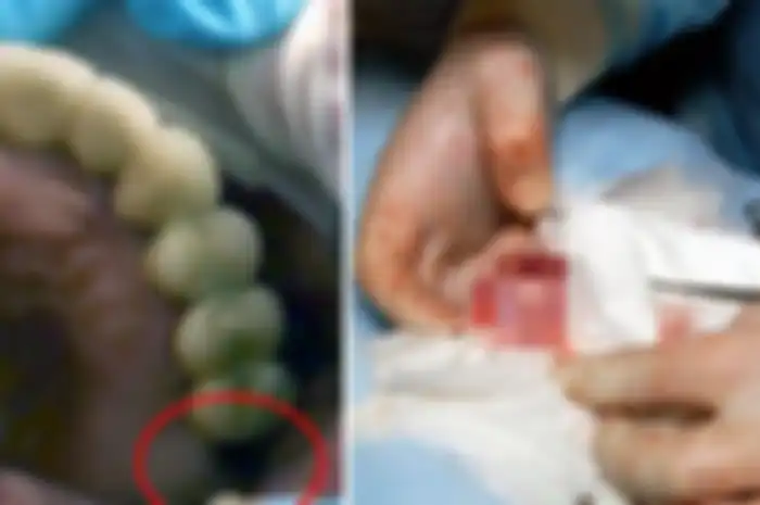 Dokter menemukan ada benjolan dalam alat vital seorang anak sekolah 13 tahun, ternyata benjolan itu adalah gigi yang seharusnya tumbuh di rahangnya.