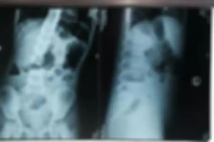 Hasil scan medis menunjukkan teratoma di dalam perut gadis tersebut.