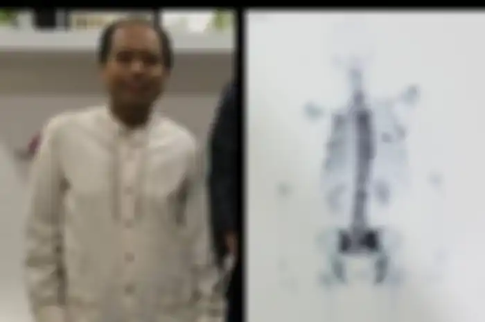 Sutopo Purwo Meninggal Usai Lawan Kanker Paru-paru, Benarkan Asap Rokok Jadi Penyebab Utama?