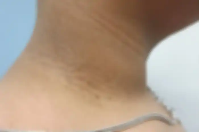 Acanthosis Nigricans