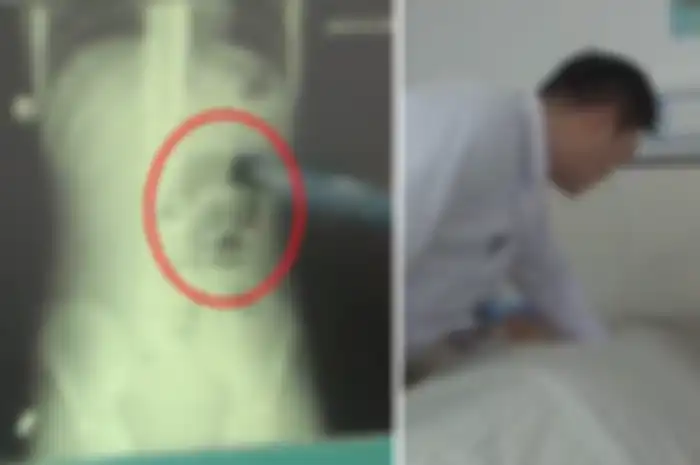 Nggak Kunyah Sampai Habis Saat Konsumsi Boba, Remaja Ini Alami Penyumbatan Usus