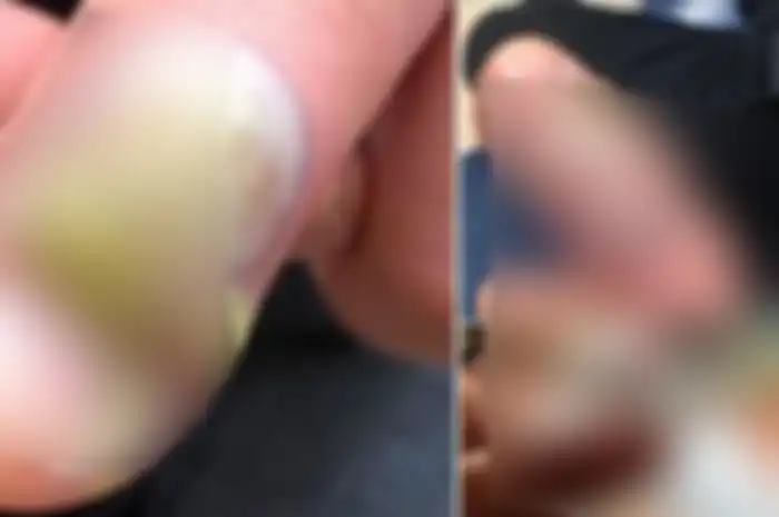 Jari tangan teman Karen yang mengalami infeksi karena kebiasaan gigit kuku.