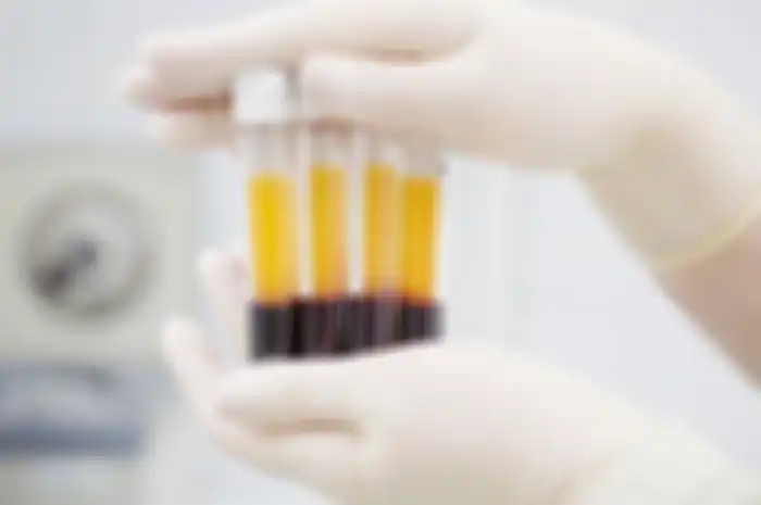 Terapi Plasma Konvalesen kini mulai diterapkan di Indonesia