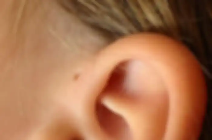 lubang kecil di telinga disebut Sinus Preauricular