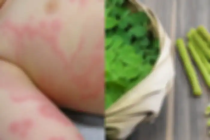 Coba obati biduran dengan antihistamin alami, antara lain: selada air, bawang putih, kelor, lidah buaya, peppermint.