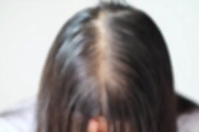 Ilustrasi rambut tipis