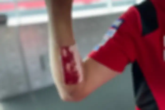 Merinding, jahitan bekas operasi pembalap tim Ducati Lenovo Team, Jack Miller terlepas saat jatuh di MotoGP Portugal 2021.
