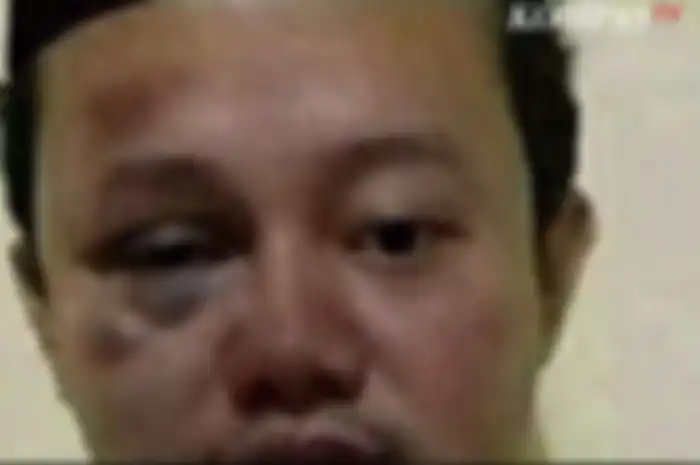 Dari foto yang beredar, pada bagian mata kanan Herry Wirawan terlihat membiru. Ada lebam seperti bekas pukulan.