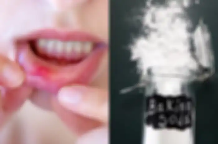 Sariawan yang menyiksa bisa sembuh dengan modal baking soda.