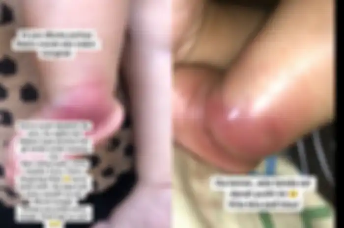 Kondisi kaki anak Evi yang semakin parah