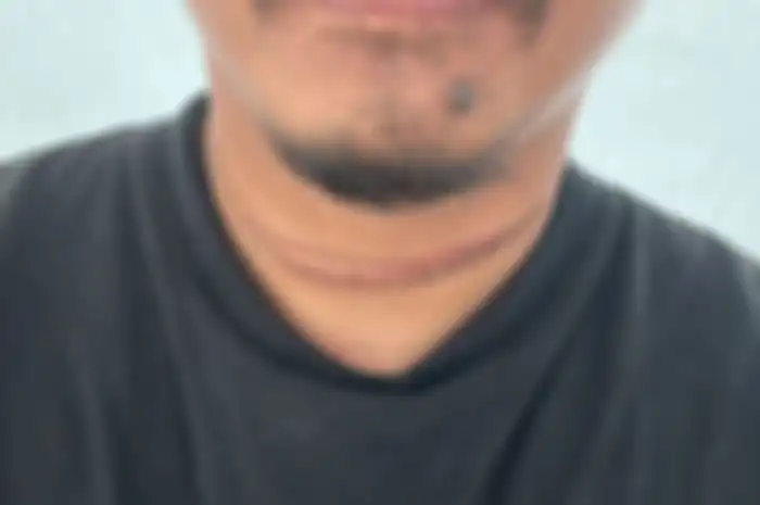 Luka yang dialami Dwi, pemotor asal Cipinang yang lehernya terluka akibat kabel fiber optik yang menjuntai. 